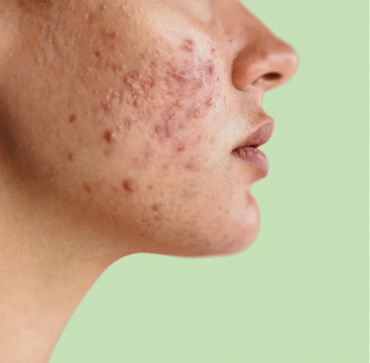 Clear Skin Ritual – Acne Be Gone Kit